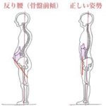 反り腰になるとどうなるの？